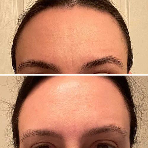 Frownies Forehead & Between Eyes Facial Patches