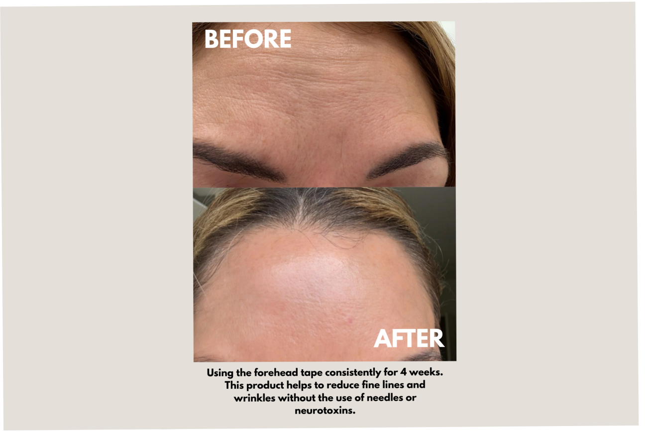 Seald™ Forehead Tape