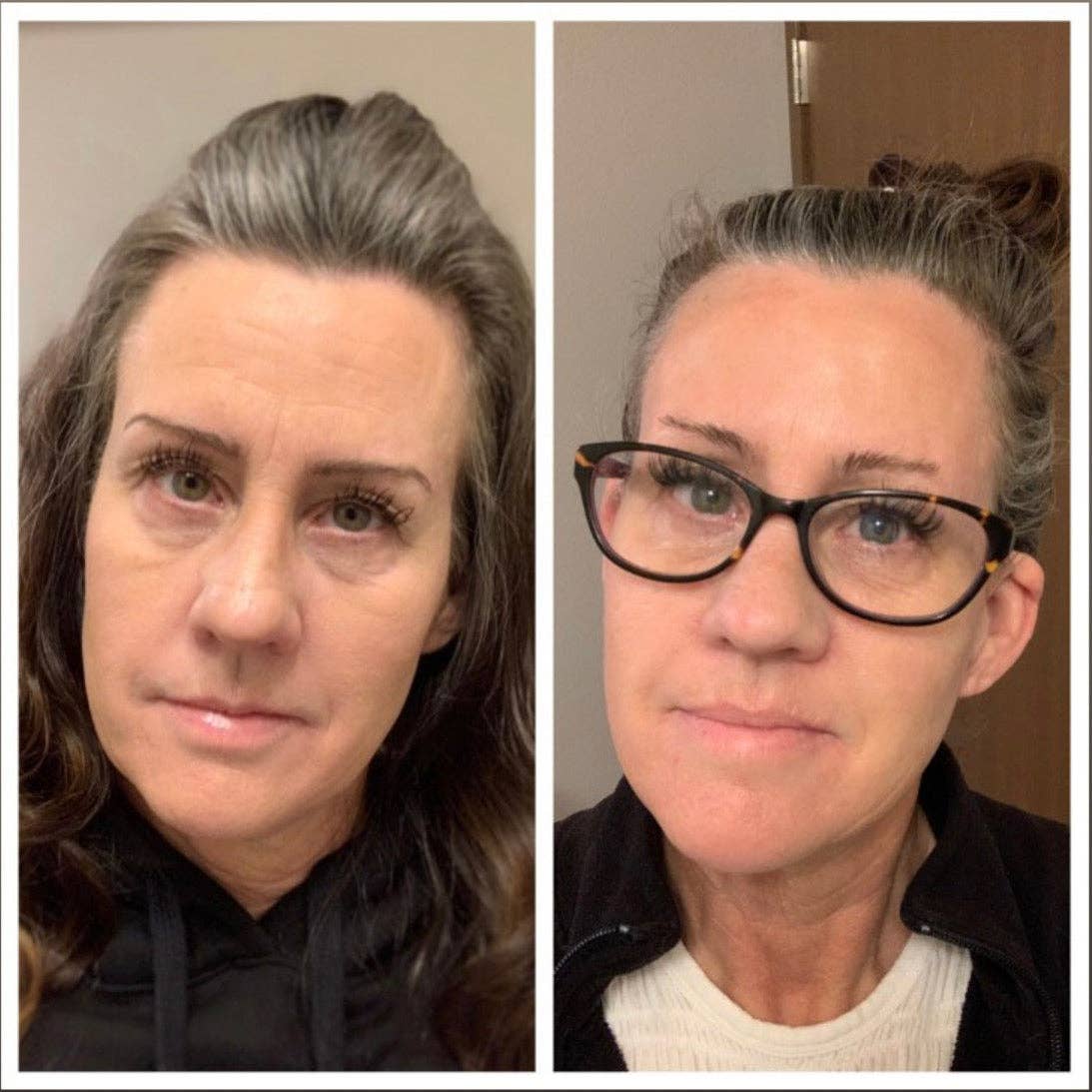 Frownies Forehead & Between Eyes Facial Patches