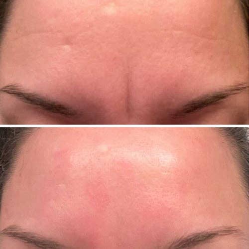 Frownies Forehead & Between Eyes Facial Patches