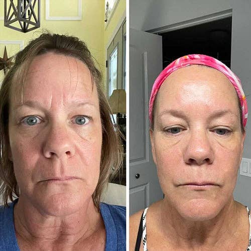 Frownies Forehead & Between Eyes Facial Patches